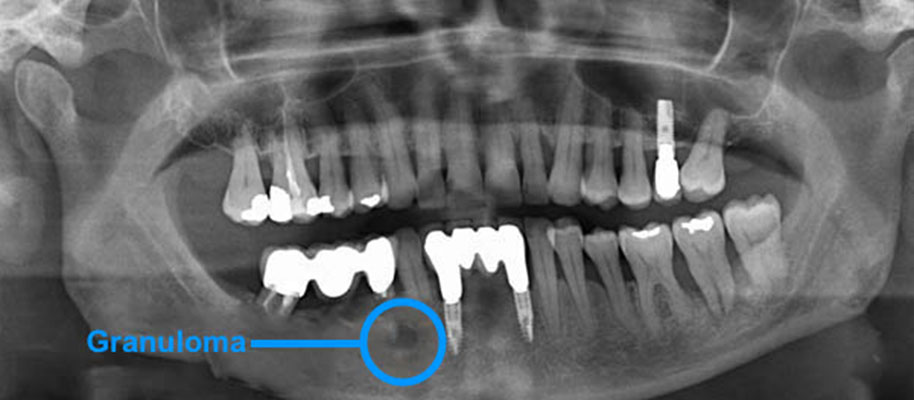 Granuloma Cos E E Perche Occorre Andare Subito Dal Dentista